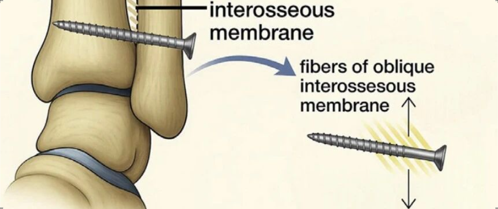 【手术技巧】下胫腓联合螺钉冠状面打歪了要紧不？