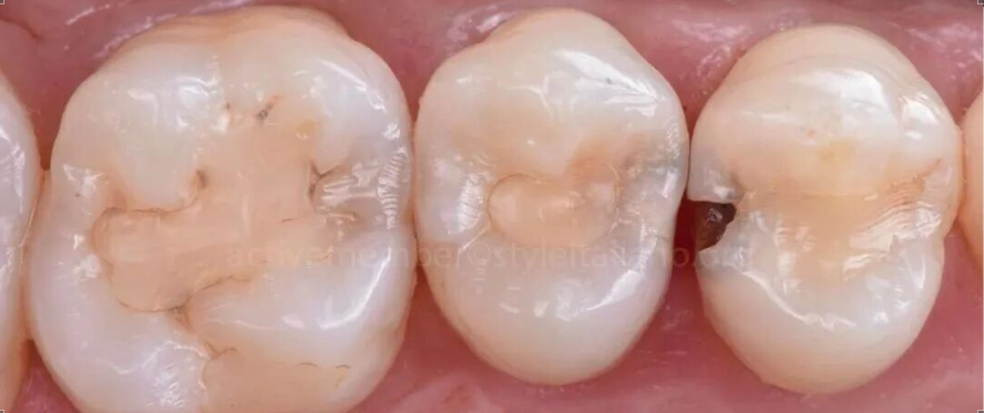 深龋：保守性单次就诊处理