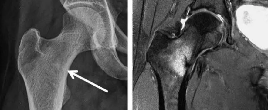 一例看不见骨折透亮线的骨折，新手估计会漏诊