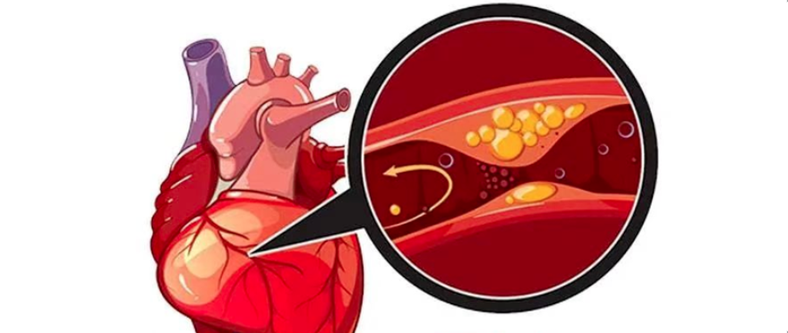 冠心病合理用药与综合管理