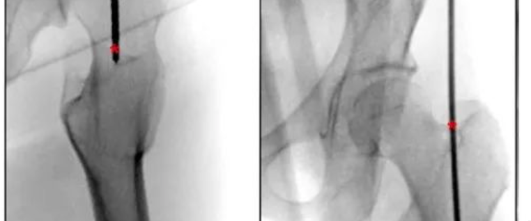 四肢骨折髓内钉固定的适应症与手术技巧