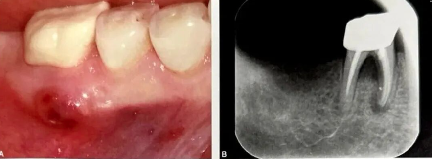 牙根纵裂的诊断和鉴别诊断