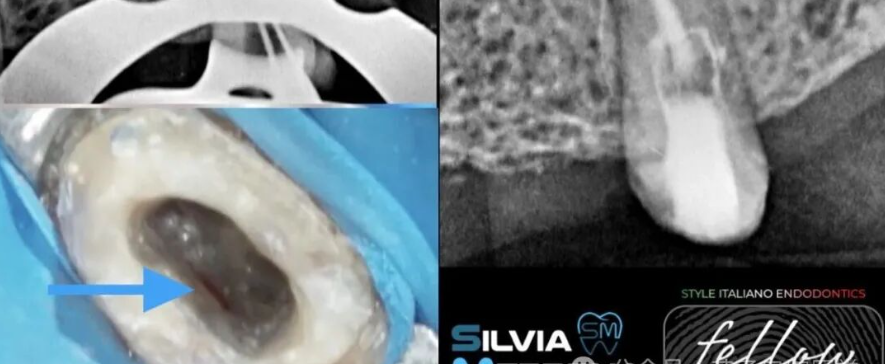 双膦酸盐患者根尖脓肿，保守治疗策略