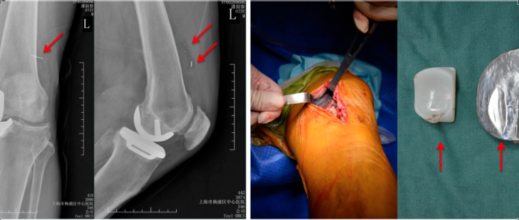 【读懂单髁】从读懂X-ray开始：术后摄片技术及垫片位置解读