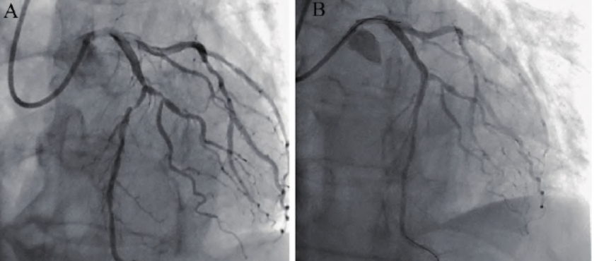 多发性肌炎误诊为非ST 段抬高型心肌梗死