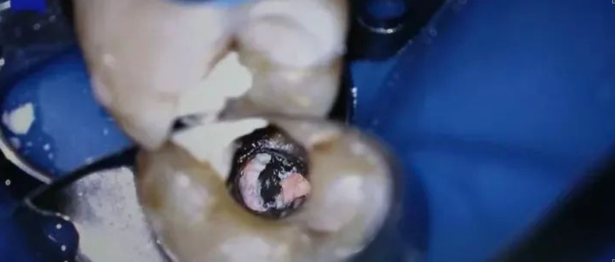 牛牙症的根管治疗步骤及案例