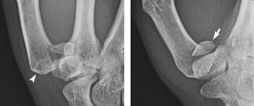 掌骨骨折、脱位影像汇总