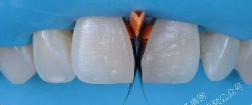 单色树脂+Front Wing技术，轻松关闭前牙缝！