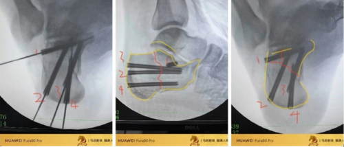 跟骨微创,无需等待消肿,无需担心切口感染、皮肤坏死