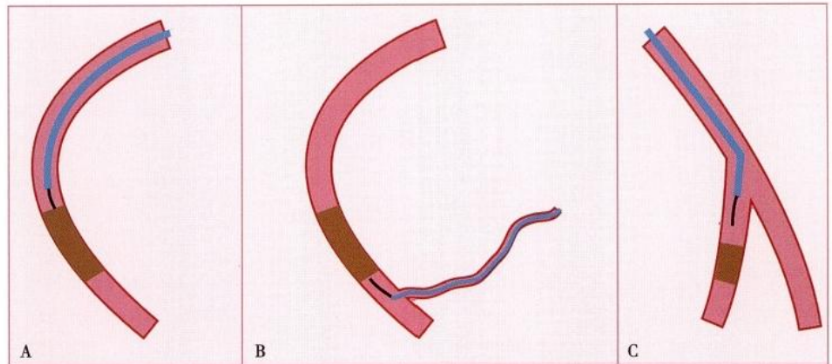 冠状动脉慢性完全闭塞病变介入治疗学习笔记：微导管的选择和操作技术