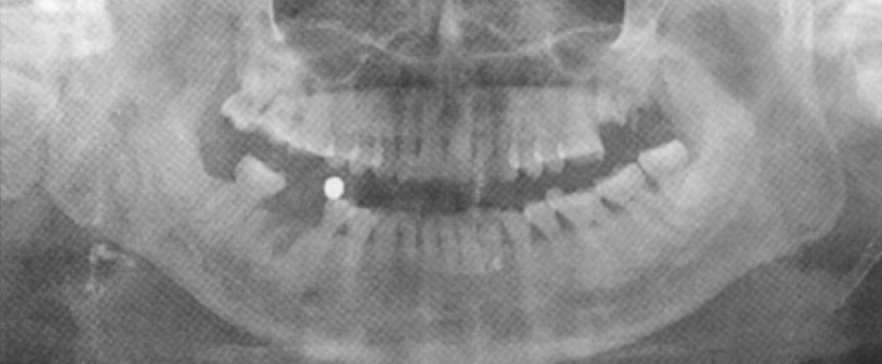 种植体挤压，致骨折片突入下牙槽神经管
