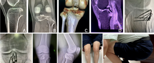 改造克氏针轻松解决后叉止点骨折