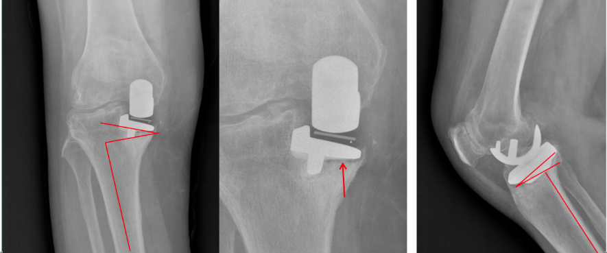【读懂单髁】从读懂X-ray开始：胫骨假体位置解读