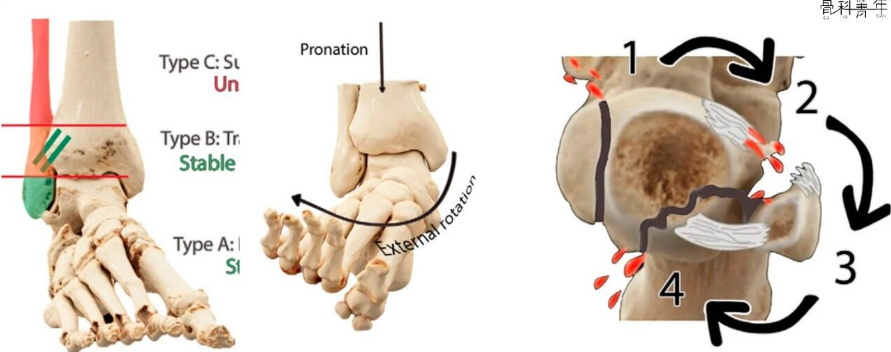 下胫腓联合损伤最全攻略｜解剖、生物力学、影像检查与术后评估