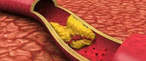 同型半胱氨酸(HCY)的临床意义