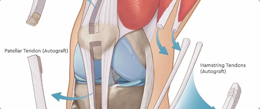 【手术理念】如果手术中移植物掉落污染了，该如何处理？