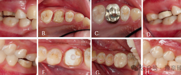 浅谈短冠磨牙的修复策略与方法