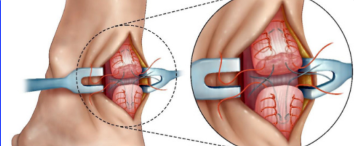【手术技术】切开修复技术治疗急性跟腱断裂