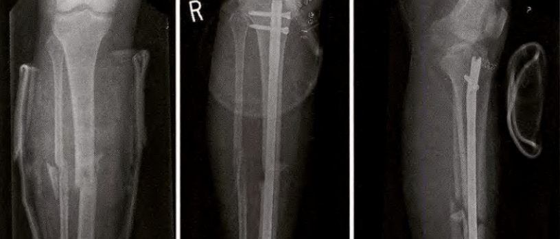 ​何时清创？如何减少感染？关于开放性骨折，你需要知道的方方面面！