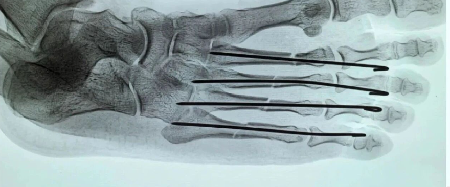 一文学会：万能克氏针，跖骨骨折的逆行髓内针技术
