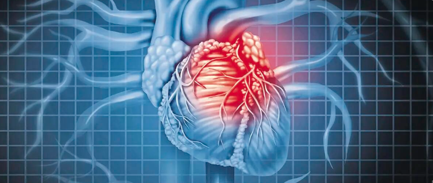 冠心病防治新策略：从关注缺血到关注动脉粥样硬化
