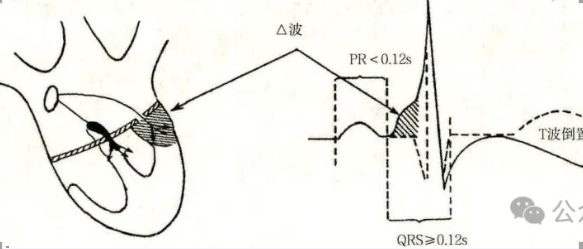 预激综合征的诊断及治疗原则