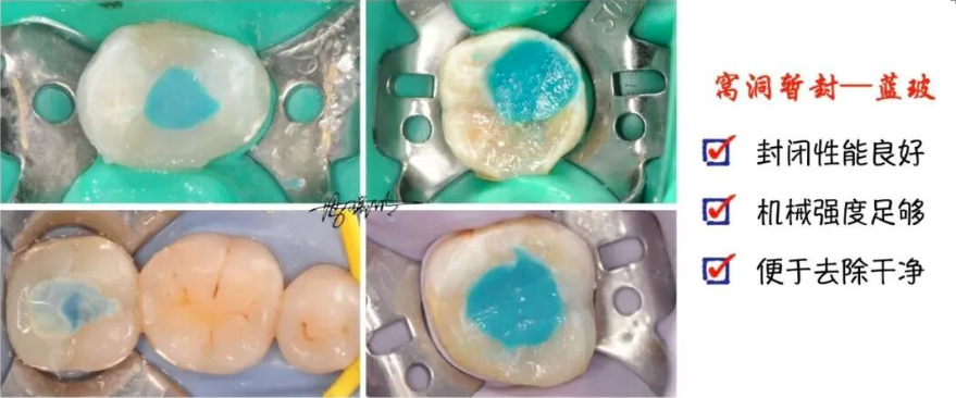 蓝玻在根管治疗中的应用