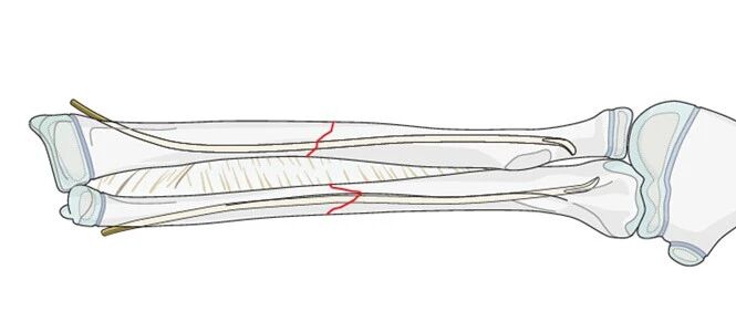 【手术技术】儿童尺桡骨双骨折的弹性髓内钉内固定（AO官网指南）