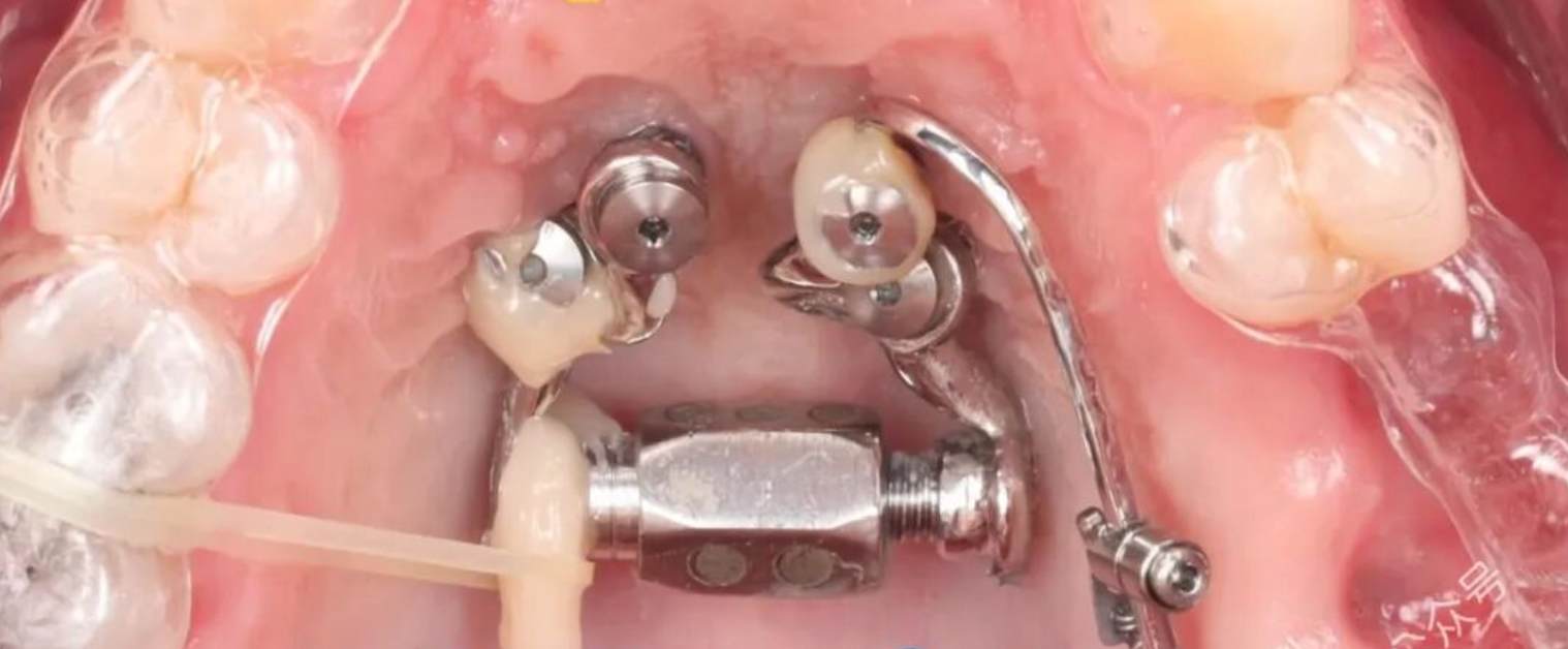 这样的正畸操作，你见过吗