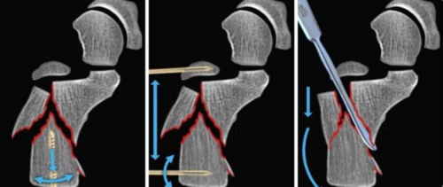 【手术技巧】跟骨骨折的规范操作技术(德国经验)