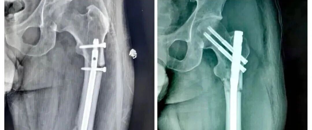 股骨干骨折为什么要“顶天立地”“能顺行不逆行”