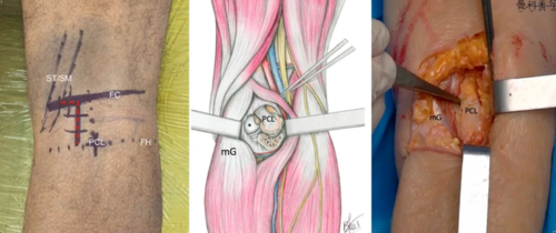 微创“Badet入路”复位固定胫骨后叉止点骨折