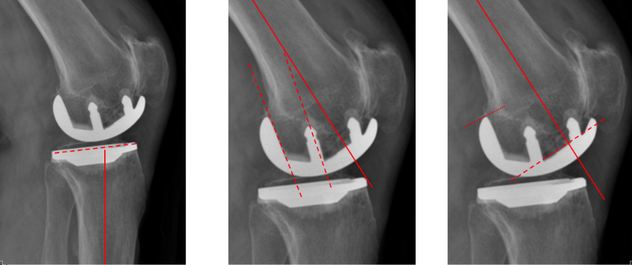 【读懂单髁】从读懂X-ray开始：固定平台单髁假体(SIGMA® HP KNEE)位置解读