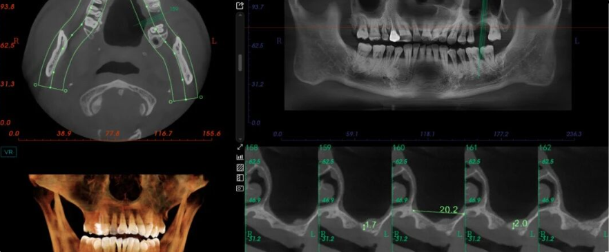 早读 | 病例分享：上颌窦外提升术一例