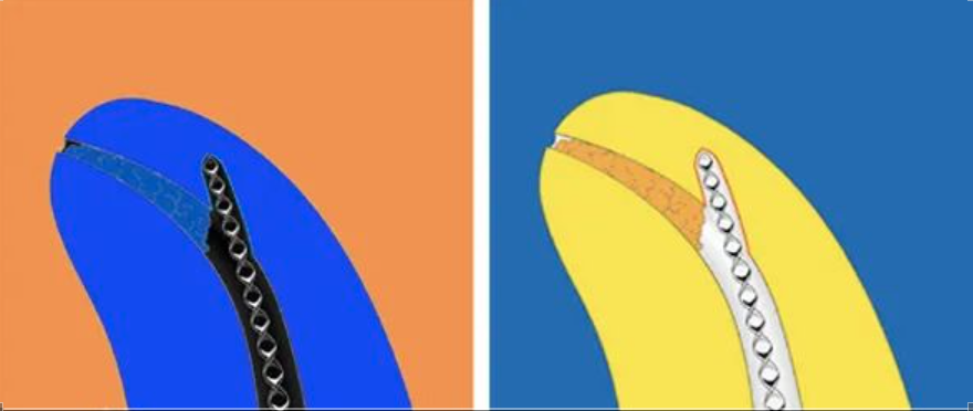 根尖偏移的三种类型，各有各的处理方法