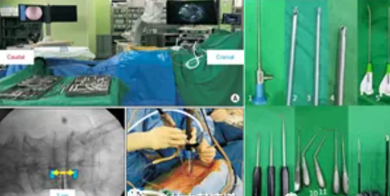 单侧双通道脊柱内镜技术（UBE/BESS），手把手教程！