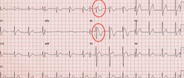 10分钟掌握Brugada综合征