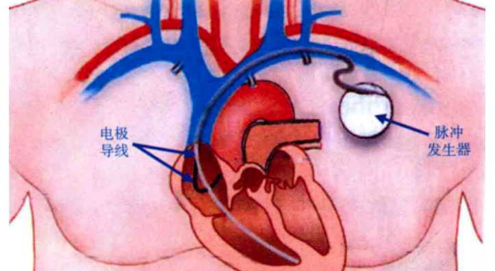 心脏起搏器参数的设定