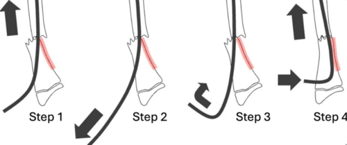【手术技巧】不仅仅是微创:弹性髓内钉如何应对儿童桡骨骨折的“不稳定”挑战?