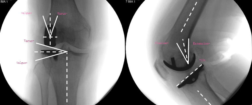 【读懂单髁】从读懂X-ray开始：固定平台单髁假体(LINK® SLED) 位置解读