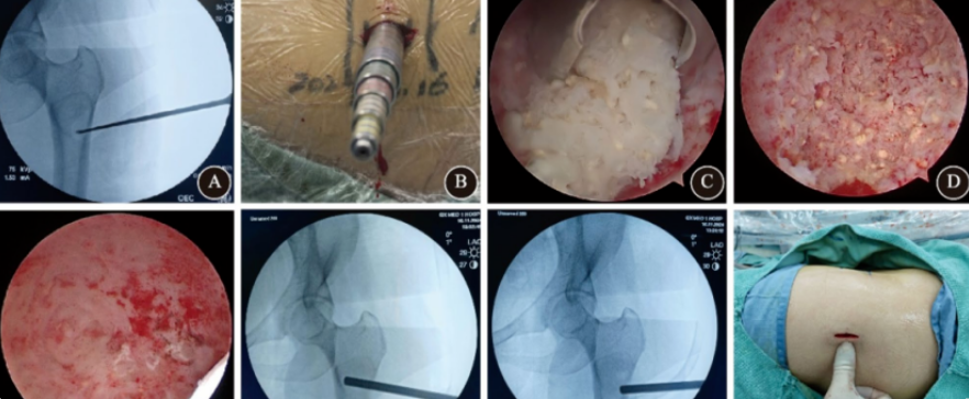 关节镜辅助单孔非同轴内镜手术治疗的前世今生
