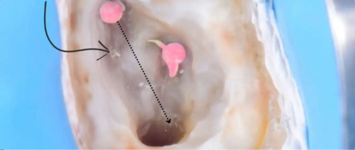 看伊朗牙体大夫的一例根管再治疗