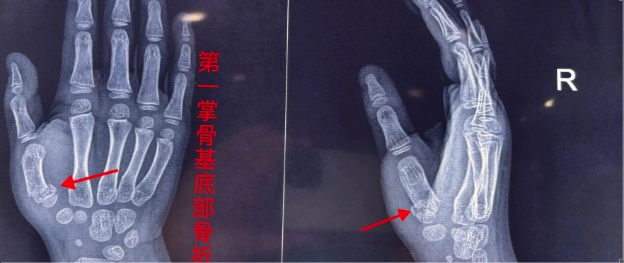 闭合复位治疗：儿童第 1掌骨基底部骨折