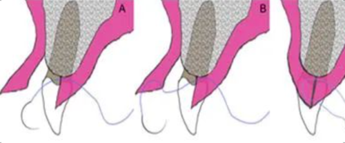 牙冠延长术具体操作,看完这篇就学会!
