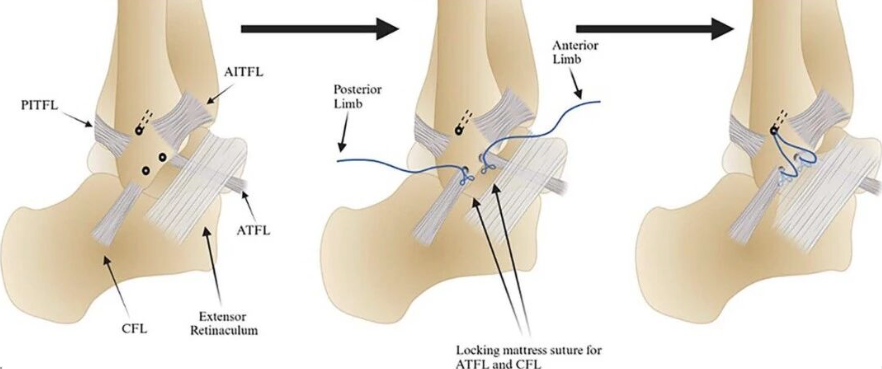 【手术技巧】新型改良 Broström‑Gould 踝关节外侧韧带增强修复术