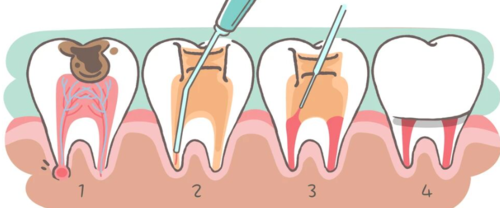 氢氧化钙+碘仿,在根管治疗中有奇用!