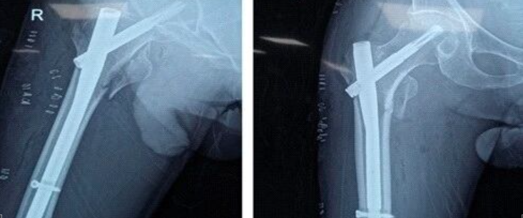 罕见病例介绍：合并外周血管疾病的股骨粗隆间骨折术后出现急性肢体缺血导致截肢。