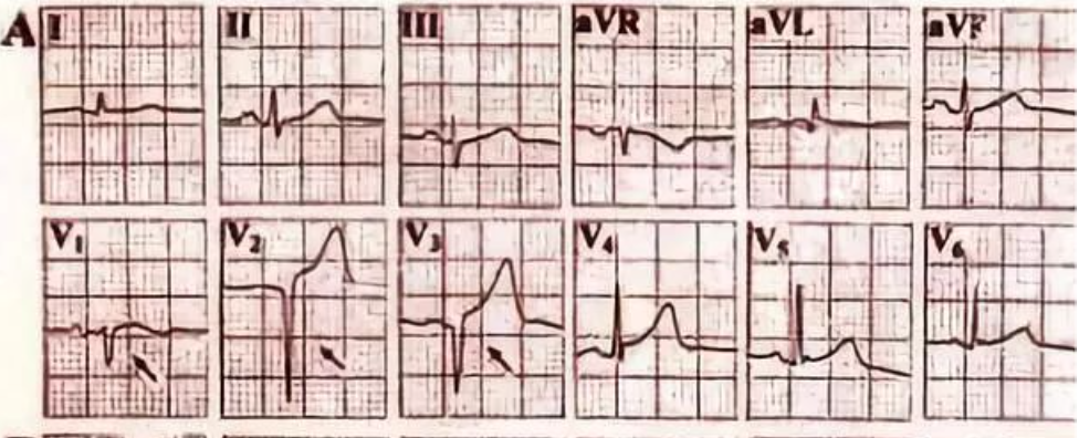 病理性Q波≠心肌梗死， 心内科医生需要牢记！