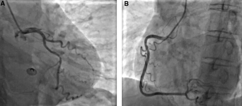 单导联ST段抬高的警报：aVL孤立抬高预示血管闭塞