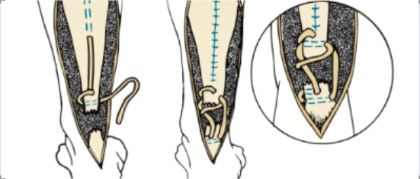 ​图文并茂：慢性跟腱断裂的最新治疗进展